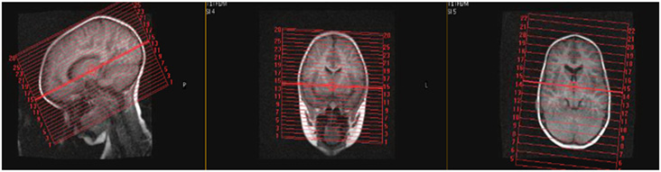 MR Quick Brain WO Neuro Protocol image
