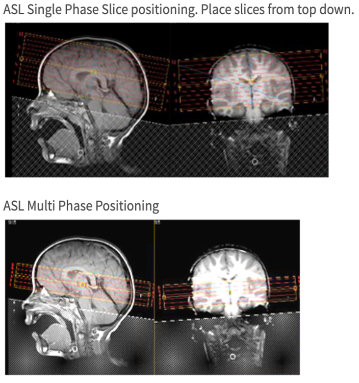  MR Stroke Brain WO Neuro Radiology Protocol image 2