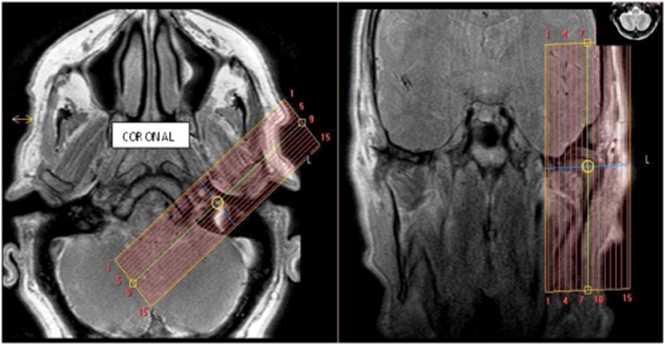 MR TMJ WO ENT Protocol image 1