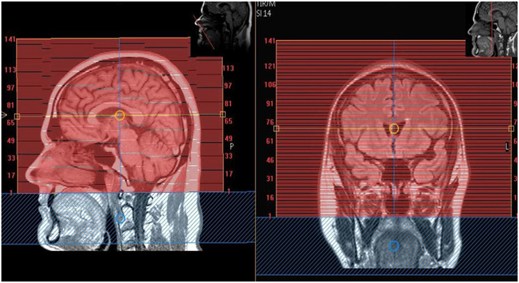 MR Framed Brain WO Pre & Post DBS Neuro Protocol