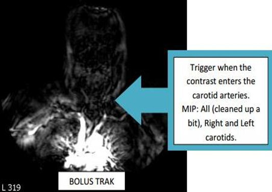 MRA Neck WWO Neuro Radiology Protocol image that shows MR Techs when to trigger the bolus trak