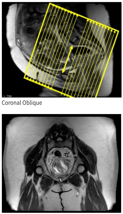  MRI Pelvimetry WO BODY Protocol image