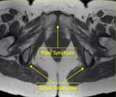 MRI Pelvis Sports Hernia WO MSK Protocol image 1