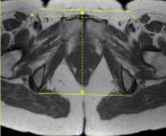 MRI Pelvis Sports Hernia WO MSK Protocol image 2