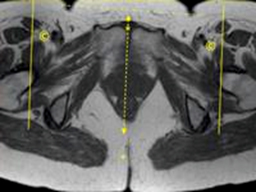 MRI Pelvis Sports Hernia WO MSK Protocol image 3