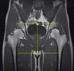 MRI Pelvis Sports Hernia WO MSK Protocol image 4