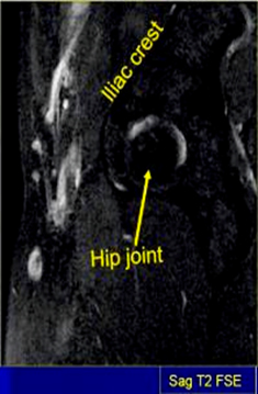 MRI Pelvis Sports Hernia WO MSK Protocol image 5