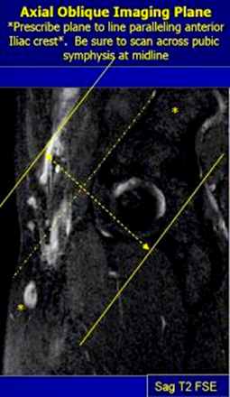 MRI Pelvis Sports Hernia WO MSK Protocol image 6