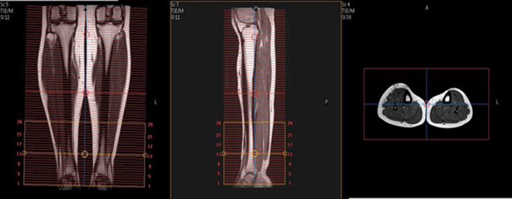 MRI Tib/ Fib WO or WWO MSK Protocol image 1