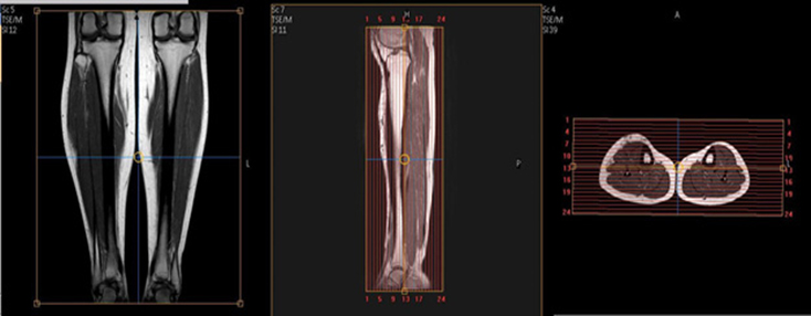 MRI Tib/ Fib WO or WWO MSK Protocol image 2