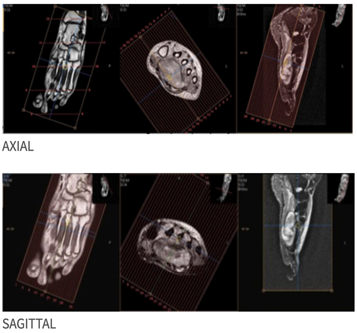 MRI Toe_Foot MSK Protocol image 2