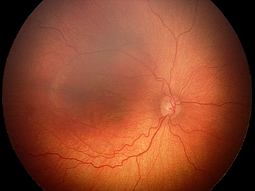 Image of a retina, which looks like an orange balloon with blood vessels snaking around it.