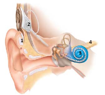 Cochlear Implant