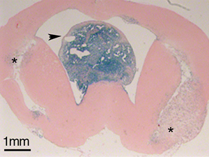 Intraventricular glioblastoma in a brain section from an adult mouse