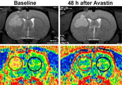 Dynamic MRI stills show that after treatment with Avastin in a rat glioma, relative cerebral blood volume decreased in the tumor