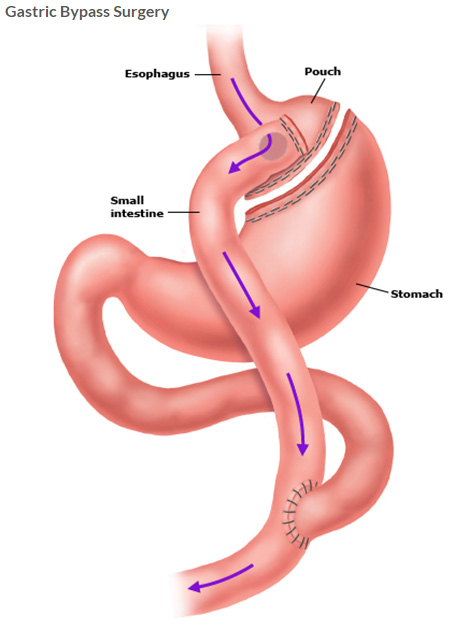 Medical illustration of roux-en-y "gastric bypass" surgery