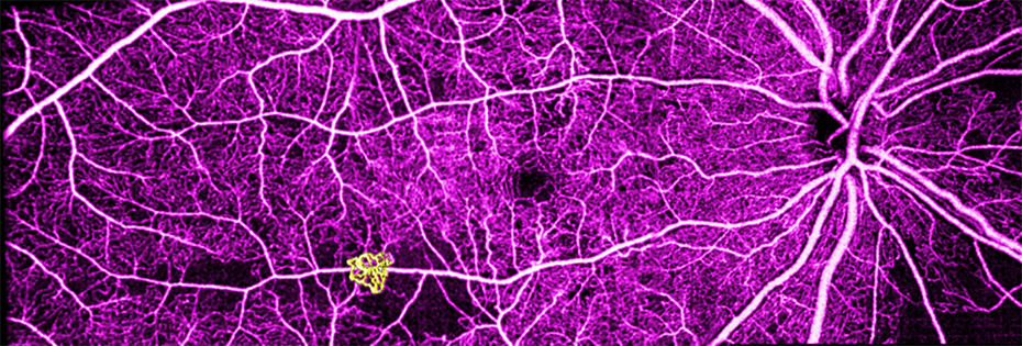 Image of retinal neovascularization taken with OCTA technology at Casey.