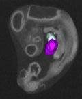 Hyperglycemic heart development visualized in chick embryo.