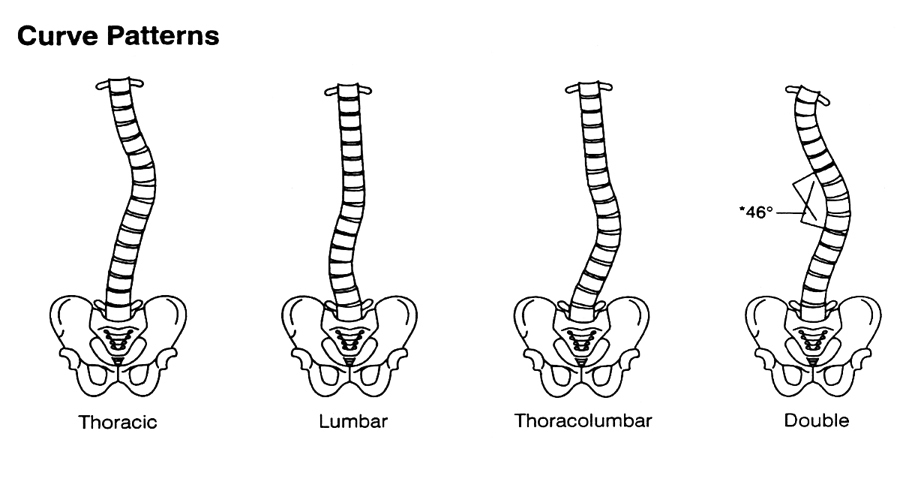 Illustration of scoliosis curve patterns