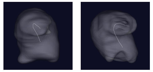 A pair of 3D images, one representing the control and the other representing the hyperglycemic treated heart. The hyperglycemic heart displays torsion (curvature).
