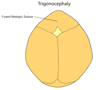 Trigonocephaly
