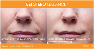 A before and after photo of cosmetic filler Belotero from the front