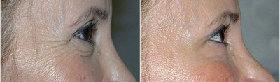 A before and after photo of Botox to see smoother skin and fewer visible wrinkles