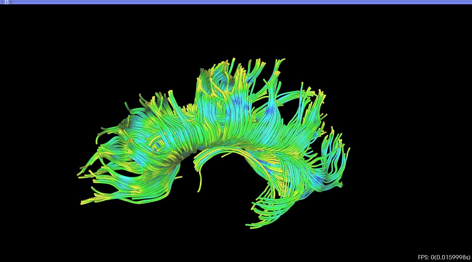 A computerized reconstruction of white matter fiber bundles.