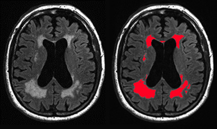 Brain image scan showing automated white matter hyperintensity segmentation