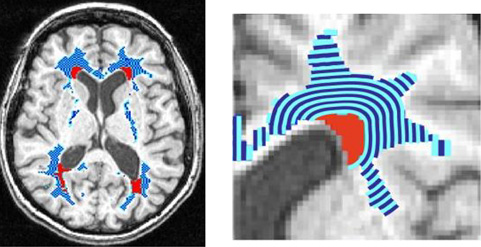 Brain image scan showing layers surrounding white matter hyperintensities where decreased blood flow predicts future expansion over time