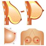 Illustration comparing the before-and-after of a breast lift procedure