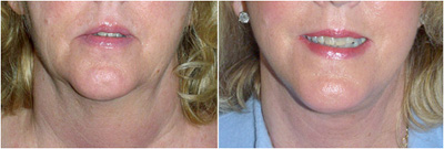 A before and after photo of face lift surgery