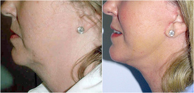 A before and after photo of face lift surgery from the side