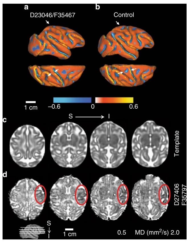 Cortical surface model and apparent diffusion coefficient (ADC) map of fetal brains.