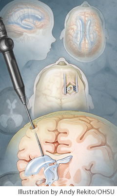 Illustration of the stages in a neuroendoscopy procedure