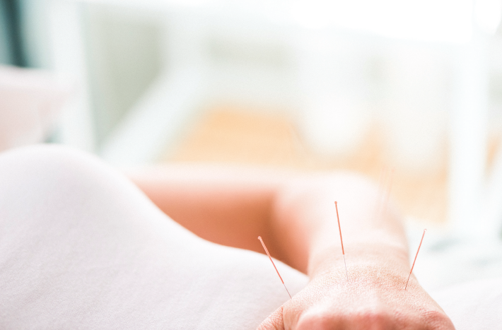 woman's hand with three acupuncture needles