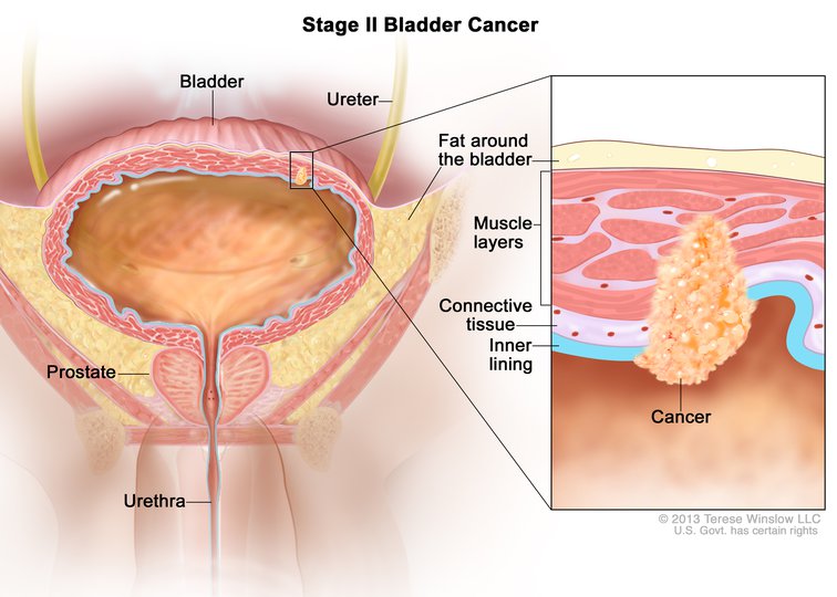 In Stage II bladder cancer, the tumor has grown from the inner lining into the bladder’s muscle layer.