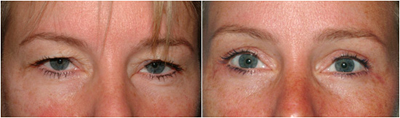 A before and after photo of an eyebrow list from viewed from the front
