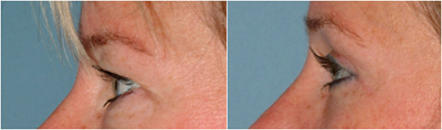 Image of before and after a brow lift viewed from the side.
