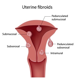Uterine Fibroid diagram
