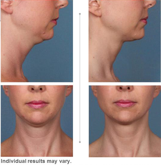 Images from the front and side showing the benefits of double chin shots