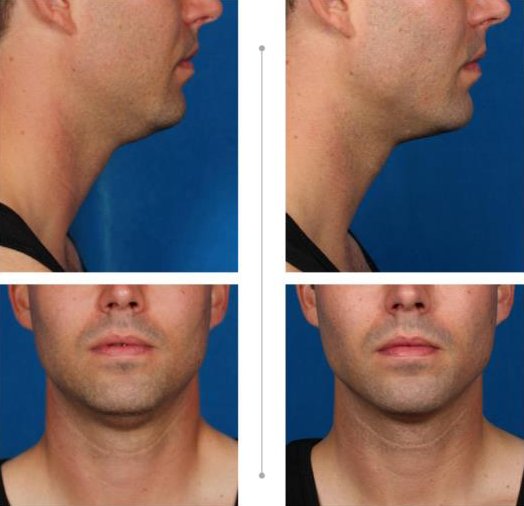 Front and side view of of a man's face to see the benefits of double chin shots