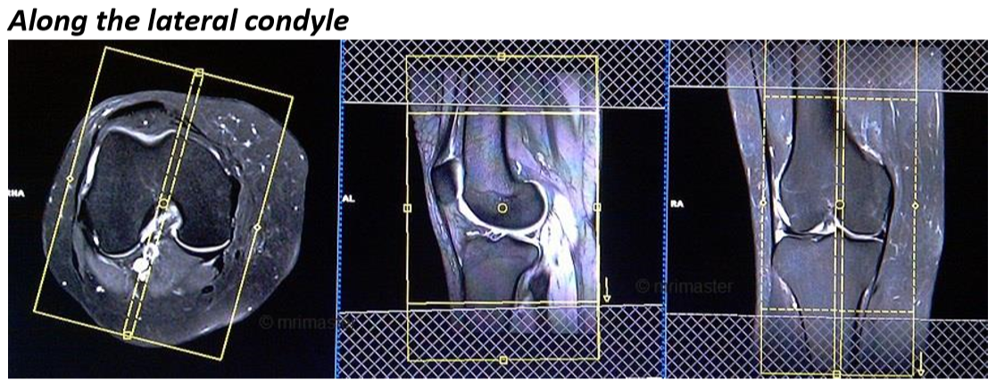 Planning Guide Along the Lateral Condyle for MRI technologists