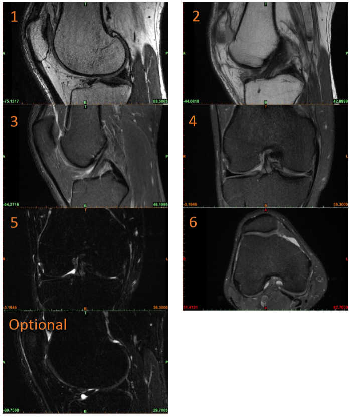 MRI Osteochondral Planning Knee - imaging example for MRI technologists
