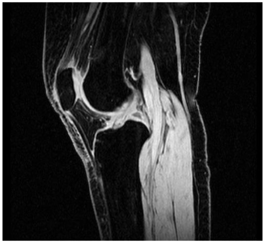 MR MATERIALISE HIGH-RES SAGITTAL KNEE IMAGE FOR MRI TECHS