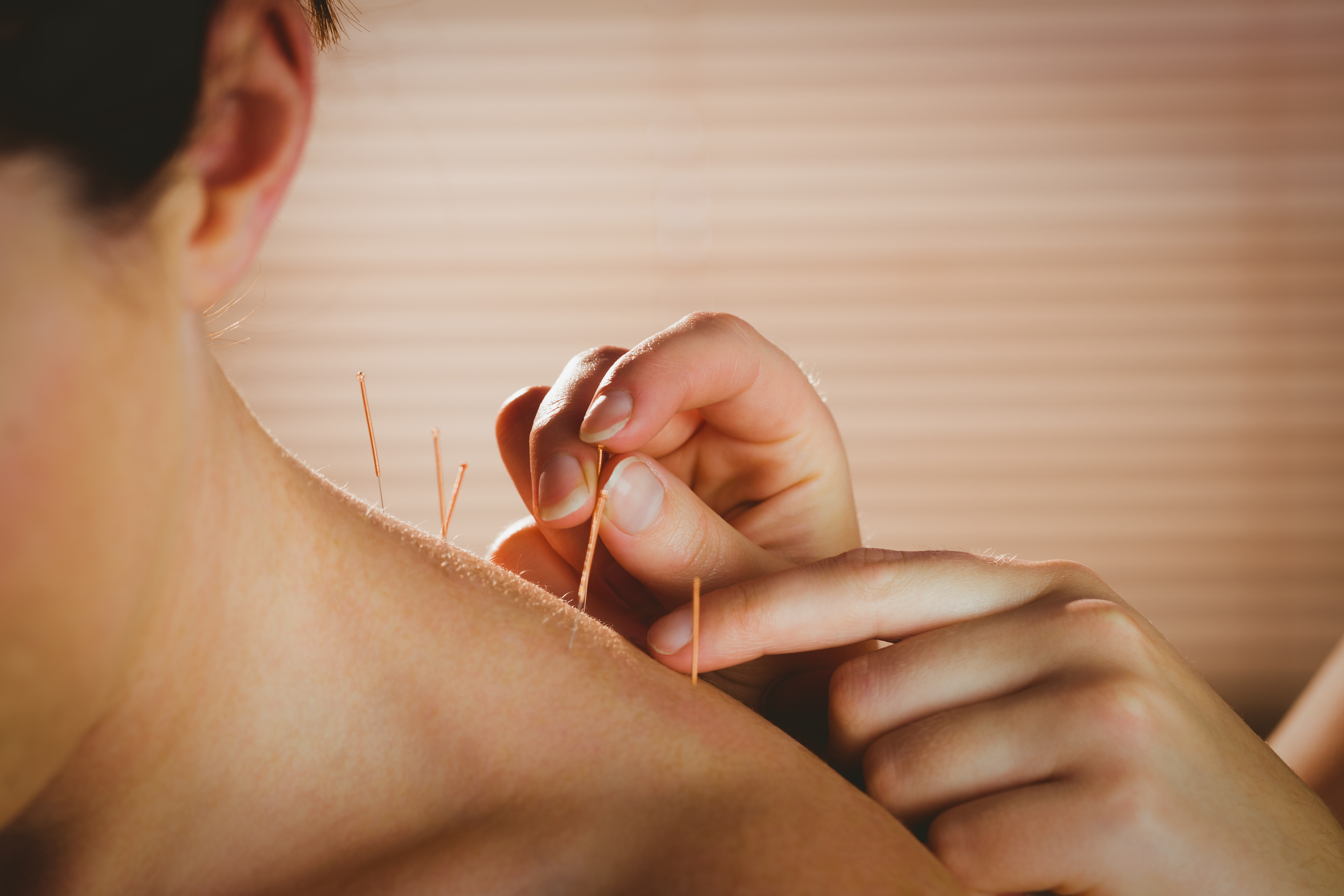 Woman leans forward as acupuncture needles are inserted in her neck and upper back