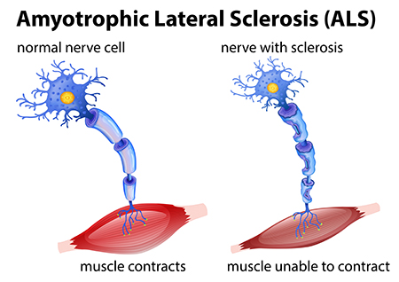 ALS diagram with nerve and muscle cell | Designed by brgfx/Freepik