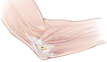 Andy Rekito/OHSU. The ulnar nerve (at the elbow, shown in yellow) can become compressed, causing pain and numbness.