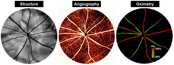 These OCT images are allowing vision researchers to see the eye in a new way and may help improve early detection for glaucoma.