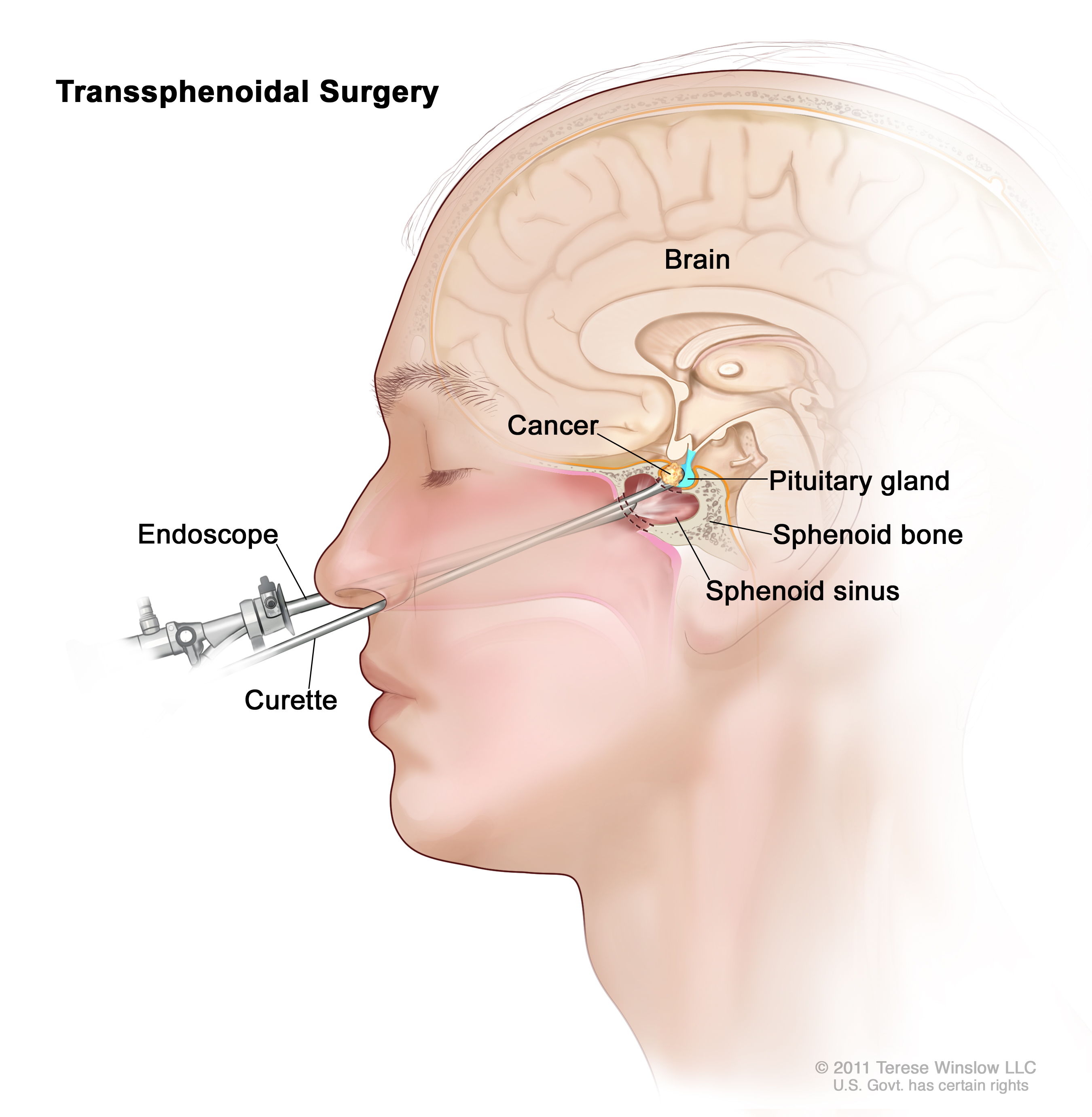 Pituitary Center | Diagram of Transsphenoidal surgery 